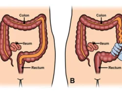 Waspada Irritable Bowel Syndrome: Gejala, Penyebab, dan Bahayanya